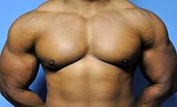 Gynecomastia Before and After Pictures Plano, TX