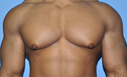 Gynecomastia Before and After Pictures Plano, TX