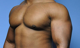 Gynecomastia Before and After Pictures Plano, TX