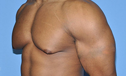 Gynecomastia Before and After Pictures Plano, TX