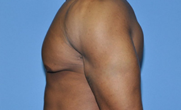 Gynecomastia Before and After Pictures Plano, TX