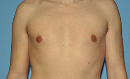 Gynecomastia Before and After Pictures Plano, TX