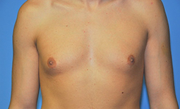 Gynecomastia Before and After Pictures Plano, TX