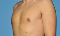 Gynecomastia Before and After Pictures Plano, TX