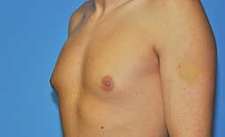 Gynecomastia Before and After Pictures Plano, TX