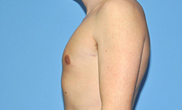 Gynecomastia Before and After Pictures Plano, TX