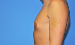 Gynecomastia Before and After Pictures Plano, TX