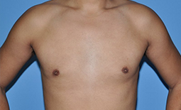 Gynecomastia Before and After Pictures Plano, TX