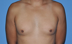 Gynecomastia Before and After Pictures Plano, TX