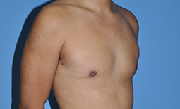 Gynecomastia Before and After Pictures Plano, TX