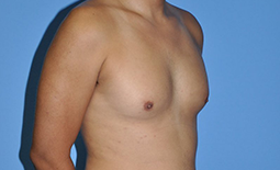 Gynecomastia Before and After Pictures Plano, TX