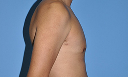 Gynecomastia Before and After Pictures Plano, TX