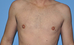 Gynecomastia Before and After Pictures Plano, TX