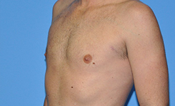 Gynecomastia Before and After Pictures Plano, TX