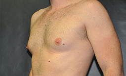 Gynecomastia Before and After Pictures Plano, TX