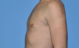 Gynecomastia Before and After Pictures Plano, TX