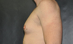 Gynecomastia Before and After Pictures Plano, TX