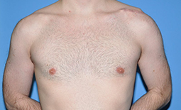 Gynecomastia Before and After Pictures Plano, TX