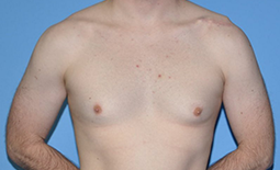 Gynecomastia Before and After Pictures Plano, TX