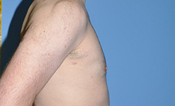 Gynecomastia Before and After Pictures Plano, TX