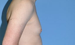 Gynecomastia Before and After Pictures Plano, TX