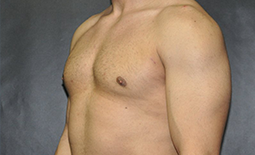 Gynecomastia Before and After Pictures Plano, TX