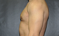 Gynecomastia Before and After Pictures Plano, TX