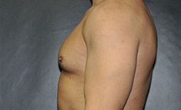 Gynecomastia Before and After Pictures Plano, TX