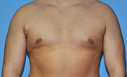 Gynecomastia Before and After Pictures Plano, TX