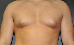 Gynecomastia Before and After Pictures Plano, TX