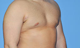 Gynecomastia Before and After Pictures Plano, TX