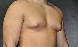 Gynecomastia Before and After Pictures Plano, TX