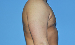 Gynecomastia Before and After Pictures Plano, TX