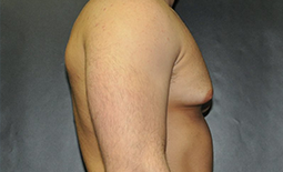 Gynecomastia Before and After Pictures Plano, TX