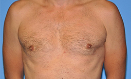 Gynecomastia Before and After Pictures Plano, TX