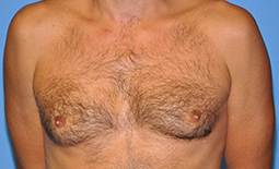 Gynecomastia Before and After Pictures Plano, TX