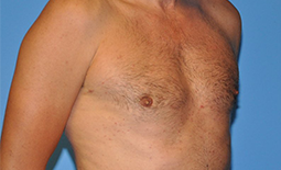 Gynecomastia Before and After Pictures Plano, TX