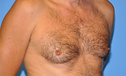 Gynecomastia Before and After Pictures Plano, TX