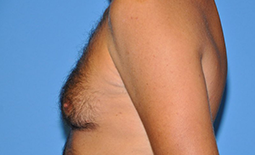 Gynecomastia Before and After Pictures Plano, TX