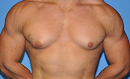 Gynecomastia Before and After Pictures Plano, TX