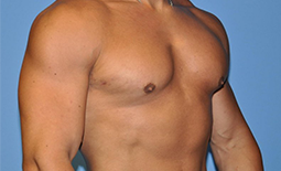 Gynecomastia Before and After Pictures Plano, TX