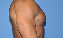 Gynecomastia Before and After Pictures Plano, TX