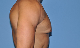 Gynecomastia Before and After Pictures Plano, TX