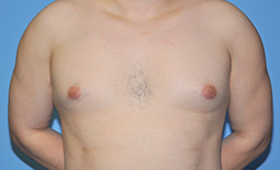 Gynecomastia Before and After Pictures Plano, TX