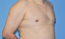 Gynecomastia Before and After Pictures Plano, TX