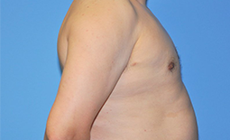 Gynecomastia Before and After Pictures Plano, TX