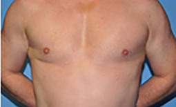 Gynecomastia Before and After Pictures Plano, TX