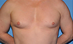 Gynecomastia Before and After Pictures Plano, TX