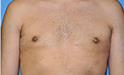 Gynecomastia Before and After Pictures Plano, TX