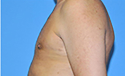 Gynecomastia Before and After Pictures Plano, TX